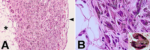 mesotelioma