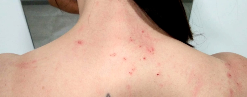 El ácaro de las ratas